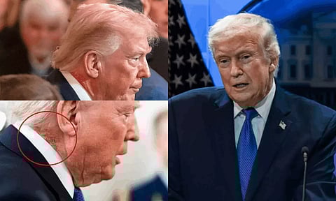 டிரம்ப் கழுத்தில் தென்பட்ட மாற்றம் - வெள்ளை மாளிகை அறிக்கையால் வெளிவந்த உண்மை!