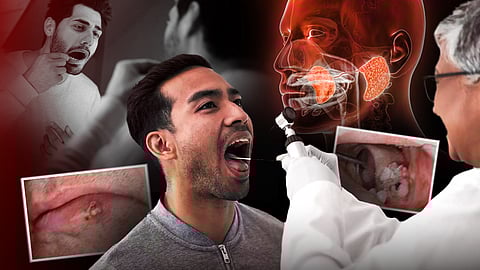 പുരുഷന്മാരിൽ വായയിലെ അർബുദം വർധിക്കുന്നു; നേരത്തെ തിരിച്ചറിയുന്നത് അതിജീവനത്തിൽ പ്രധാനം