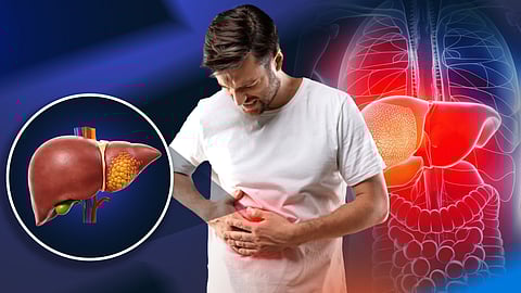 മദ്യപിക്കാത്തവരിലും കരൾ രോഗം വർധിക്കുന്നു; വീട്ടുഭക്ഷണത്തിലെ ഒളിഞ്ഞിരിക്കുന്ന വില്ലൻ 