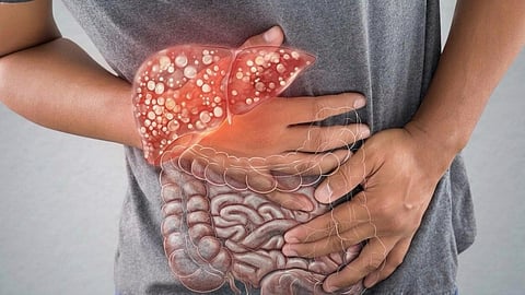 ലോകത്തിനു വെല്ലുവിളിയായി ഉപാപചയ കരള്‍ രോഗം, 2050ല്‍ 200 കോടിയോളം രോഗികള്‍; കാരണങ്ങള്‍ ഇതാണ്