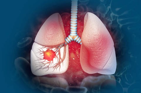 The most common types of lung cancer include non-small cell carcinoma or NSCLC and small cell carcinoma or SCLC. 