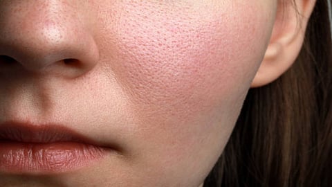 Heavy make-up and frequently avoiding proper cleaning can also be a chief cause of open pores. 