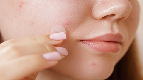 Cystic and nodular acne can cause permanent damage to the skin in the form of scars. 