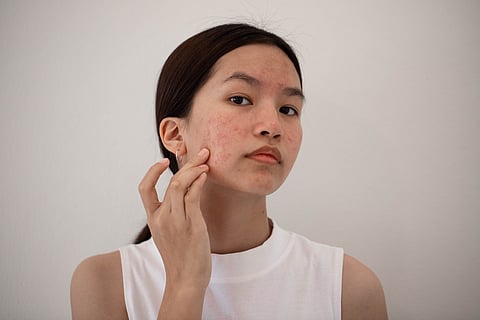 Simple ways to manage acne 