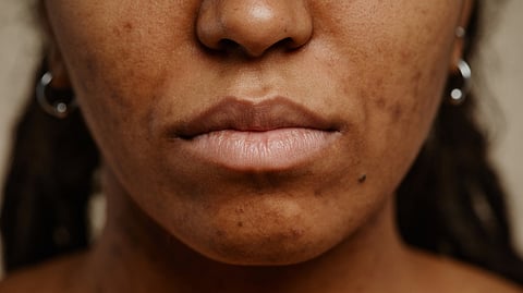 A women suffering from darkspots and hyperpigmentation.
