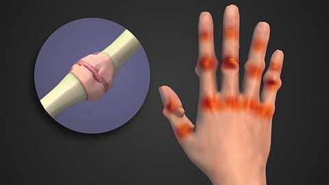 RA and psoriatic arthritis (PsA) have emerged as the most common types of autoimmune arthritis. 