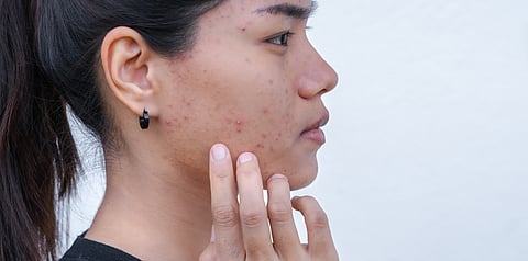 A women suffering from acne scars.