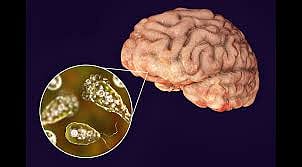 കേരളത്തില്‍ ഒരാള്‍ക്ക് കൂടി മസ്തിഷ്‌ക ജ്വരം സ്ഥിരീകരിച്ചു
