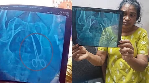 വയറ്റിൽ 5 വർഷമായി കത്രിക; ശസ്ത്രക്രിയക്കിടെ മറന്നുവെച്ചതെന്ന് പരാതി