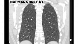 E-cigarette or Vaping Product useassociated Lung Injury Epidemic