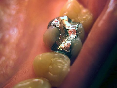 Close-up intraoral photograph showing a molar tooth with a silver amalgam filling.