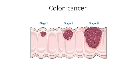 More than 93% of colorectal cancer cases occur in people 45 years old or older.