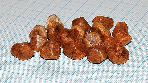 gall stones