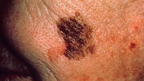 UVA’s melanoma trial will evaluate the safety and effectiveness of focused sound waves for augmenting the benefits of immunotherapy. (Representational image: CDC phil)