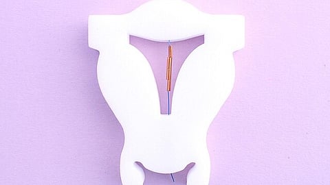 The American Academy of Pediatrics recommends IUDs as one of the first-line options for contraception in teens and young adults. (Image: Wikimedia Commons)