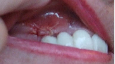 Extraction socket with bone graft and barrier membrane (Representative image: Wikimedia Commons)