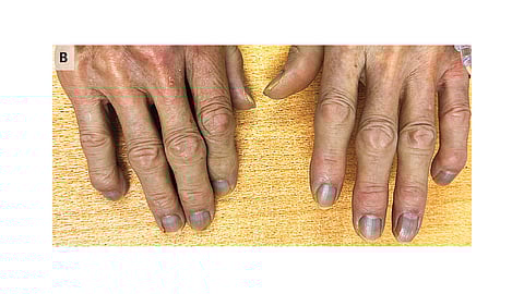 Silver ions tend to accumulate in various tissues, including the skin, heart, liver, lungs, and even the brain. (Image Credits: The New England Journal of Medicine)