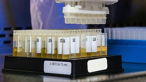 The urine test, called MyProstateScore 2.0, or MPS2, looks at 18 different genes linked to high-grade prostate cancer.