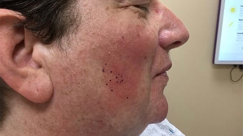 Microscopic view of skin inflammation in Cutaneous Lupus Erythematosus. (Wikimedia Commons)