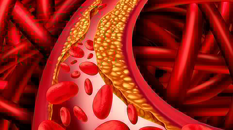 Study Reveals Shocking Results: "Good Cholesterol" Linked to Development of Glaucoma. (Representational image: Wikimedia Commons)