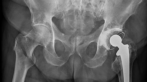 X-Ray of hip after hip replacement surgery.