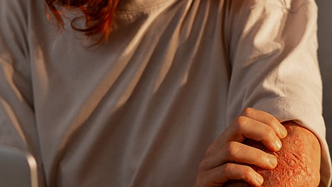 A woman suffering from a rash