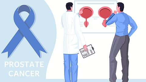 An illustration about prostate cancer with a healthcare professional and a patient discussing about it.