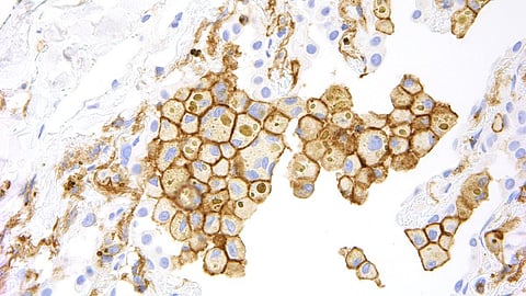 Microscopic image of abnormal lung cancer cells.