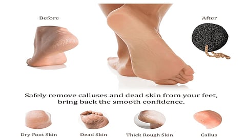 An image showing nude feet showing cracked heels and a black pumice stone.