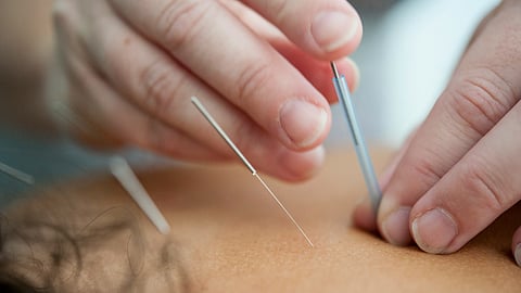 Acupuncture needles used on the patient
