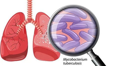 Illustration of lungs and a magnifying glass highlighting Mycobacterium tuberculosis inside.
