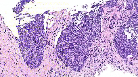 A histological picture of lung tissue stained purple and pink using H&E stain, showing areas of lung tissue.