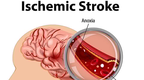 A medical illustration of a blood vessel rupture in brain titled Ischemic Stroke.
