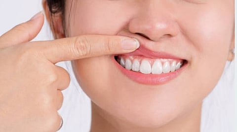 A healthy gum and teeth of a woman.
