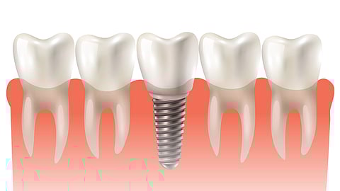 An illustration of a model of a dental implant among natural teeth.