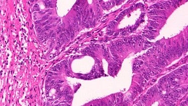 The picture shows a pink and purple-stained micrograph of a moderate colorectal carcinoma.