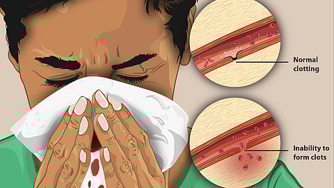 A woman with a cold is blowing her nose into a tissue which is stained with blood, looking uncomfortable and fatigued.