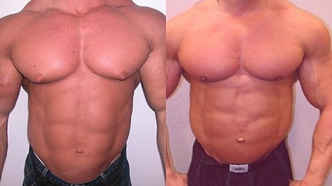 A before and after surgery pictures of a man with gynecomastia after breast reduction surgery.