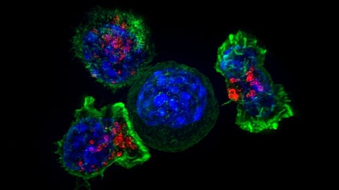 Super resolution of cancer cells in fluorescent colors surrounded by T-cells.