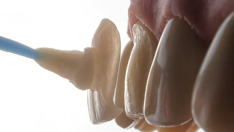 Close-up of a dental procedure placing veneer onto a tooth.