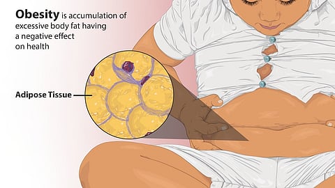 Depiction of a teenage with obesity.