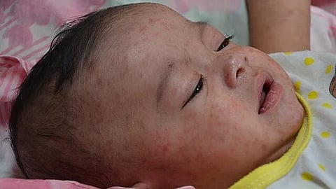 A photo of face of child lying down supine with rashes all over face and wearing white t-shirt with yellow dots on it.