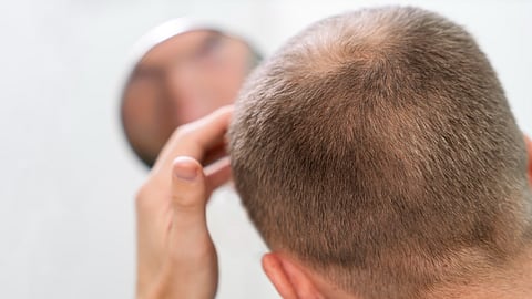 A bald person checking the hair loss in the mirror.