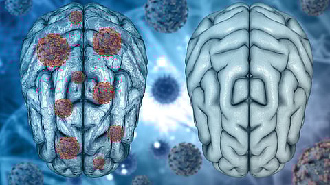 3D rendered image showing a comparison between a healthy brain and a COVID-19-affected brain.