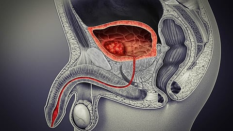 3D image showing a cross-sectional image with bladder cancer. 