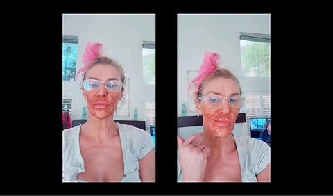 Brandi Glanville with her skin condition 