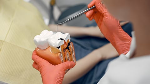 Image shows tooth implant model.