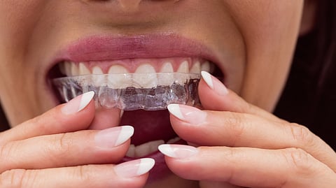 A woman inserting a clear aligner tray into her mouth.