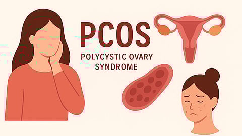 A poster for PCOS, showing an animated picture of a uterus, an ovary with multiple cysts, a sad female with acne and another sad girl.