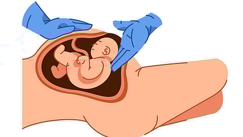 A hand drawn picture of a c-section delivery.